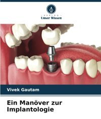 Ein Manöver Zur Implantologie: De Gautam, Vivek Verlag Unser Wissen