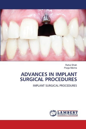 Advances In Implant Surgıcal Procedures: Implant Surgıcal Procedures Shah, Rahul Lap Lambert Academic Publishing